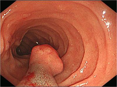 Is Gangliocytic Paraganglioma Designated as a Subtype of Composite Paragangliomas and Originated From Pancreas Islet? A Case Report and Review of Literature